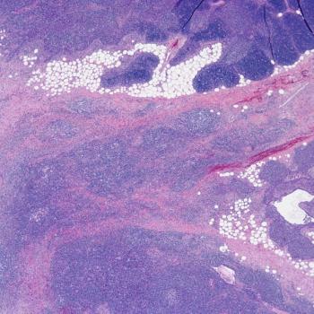 Investigators will assess AFM13 in combination with AB-101 as a treatment for those with relapsed or refractory Hodgkin lymphoma in the phase 2 LuminICE-203 trial.