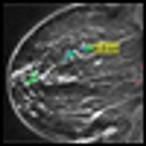 Ductal Carcinoma in Situ