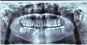 Exploring the Changing Diagnostic Criteria of Gorlin-Goltz Syndrome: A Case Report