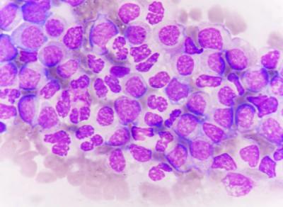 Although more recent drugs with a different mechanism of action are continuing to improve the treatment landscape, there is still work to be done to improve quality of life and achieve a cure for patients with chronic myeloid leukemia.