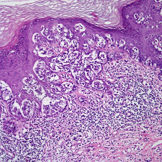 Woman Presents With Vulvar Lesion | Cancer Network