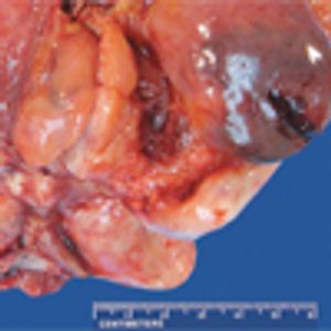 Seventy-Year-Old Man With Large Bladder Mass: Diagnostic and Clinical Challenges of an Uncommon Neoplasm 