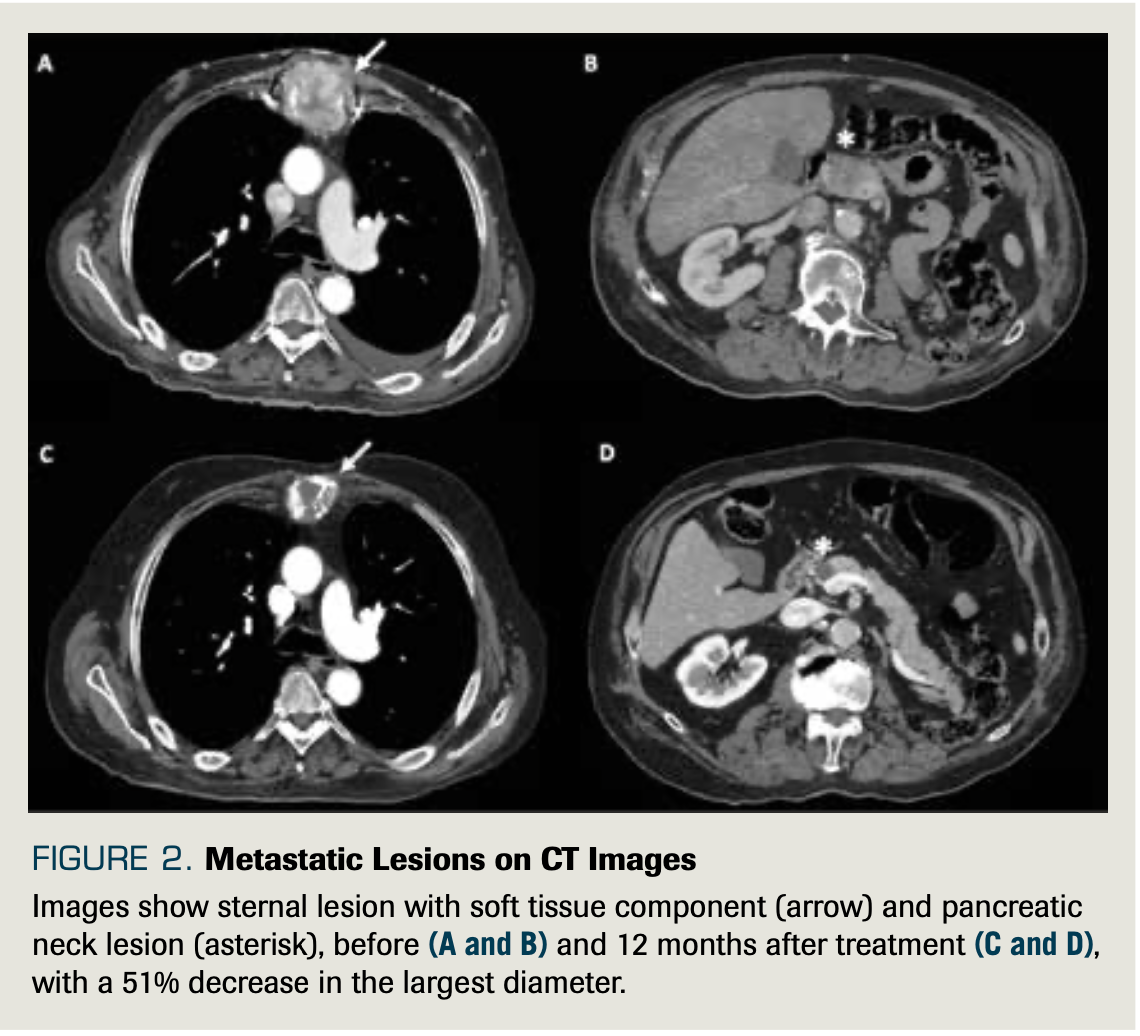 FIGURE 2. Metastatic Lesions on CT Images  

Images show sternal lesion with soft tissue component (arrow) and pancreatic neck lesion (asterisk), before (A and B) and 12 months after treatment (C and D), with a 51% decrease in the largest diameter.