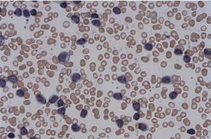 CLL14 Trial: Fixed-Duration Chemotherapy-Free Regimen for Frail Patients with Treatment-Naïve CLL