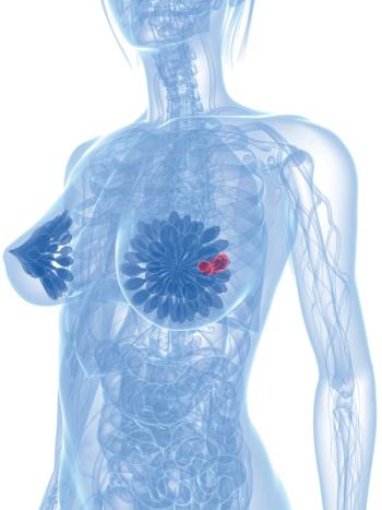 Retrospective analysis found that cryoablation was associated with infrequent AEs and low recurrence rates among patients with breast cancer.