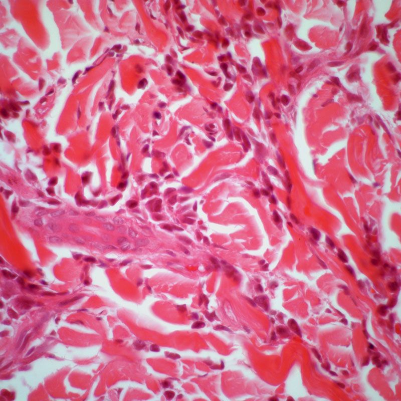 Data from the phase 3 ASCERTAIN trial support the European Commission’s approval of oral decitabine and cedazuridine as a treatment for those with newly diagnosed acute myeloid leukemia.