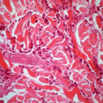 Data from the phase 3 ASCERTAIN trial support the European Commission’s approval of oral decitabine and cedazuridine as a treatment for those with newly diagnosed acute myeloid leukemia.