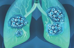 3 Things You Should Know About New Treatments for MET-Altered NSCLC