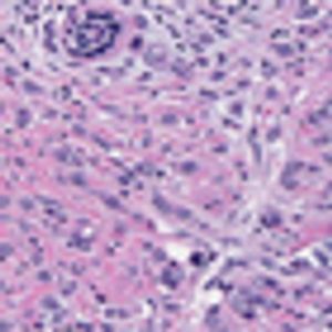 Human Lobular Breast Cancer