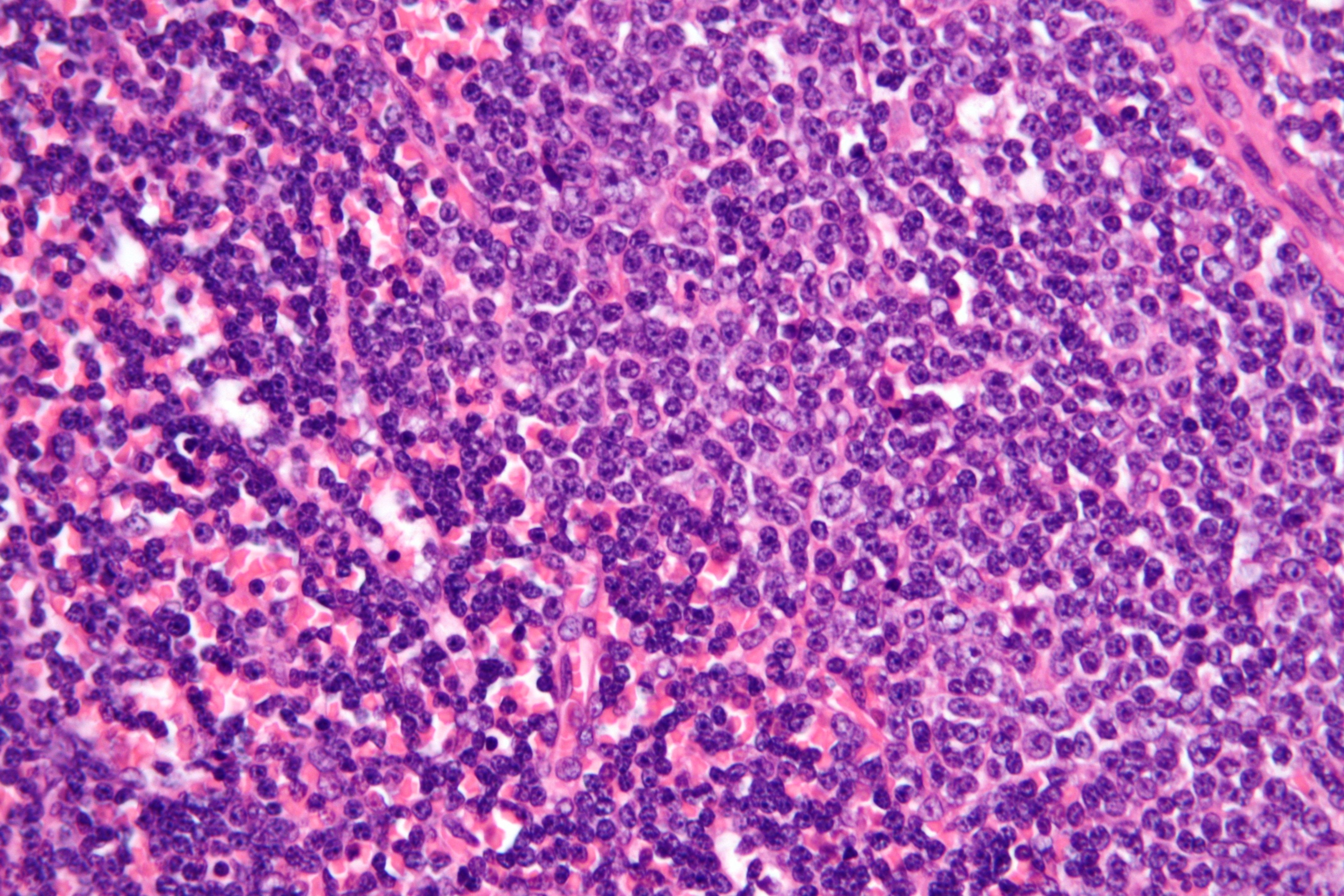 Chronic lymphocytic leukemia 