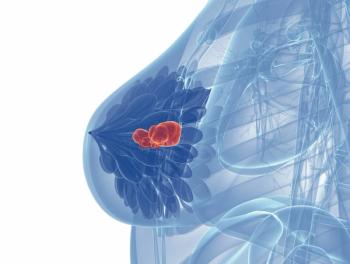 Equivalent Toxicity, PROs Noted With Higher Radiation Dose Over Fewer Fractions After Breast Conserving Surgery