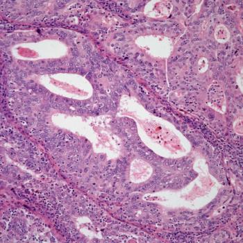 Preliminary overall survival data with atezolizumab plus bevacizumab and chemotherapy in recurrent ovarian cancer in the phase 3 ATALANTE trial appear to warrant further analysis.