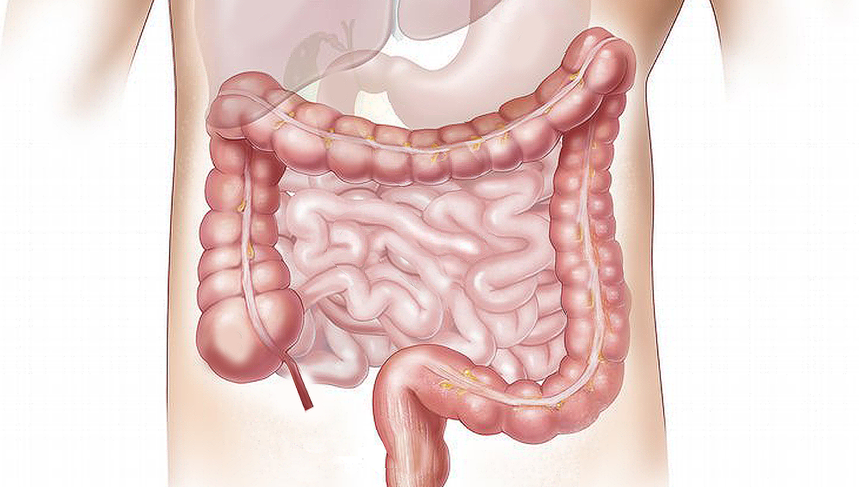 Cost-utility analysis of the CHALLENGE trial showed structured exercise following adjuvant chemotherapy for colon cancer is cost-saving and improves QALYs.