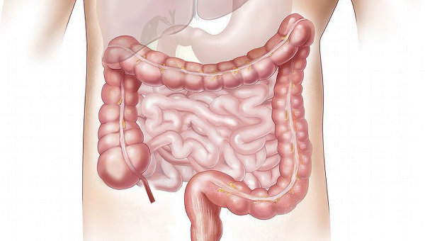 Cost-utility analysis of the CHALLENGE trial showed structured exercise following adjuvant chemotherapy for colon cancer is cost-saving and improves QALYs.