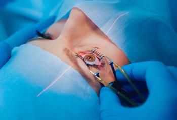 Laser vision correction. A patient and team of surgeons in the operating room during ophthalmic surgery. Eyelid speculum. Lasik treatment.| Image Credit: © romaset-stock.adobe.com