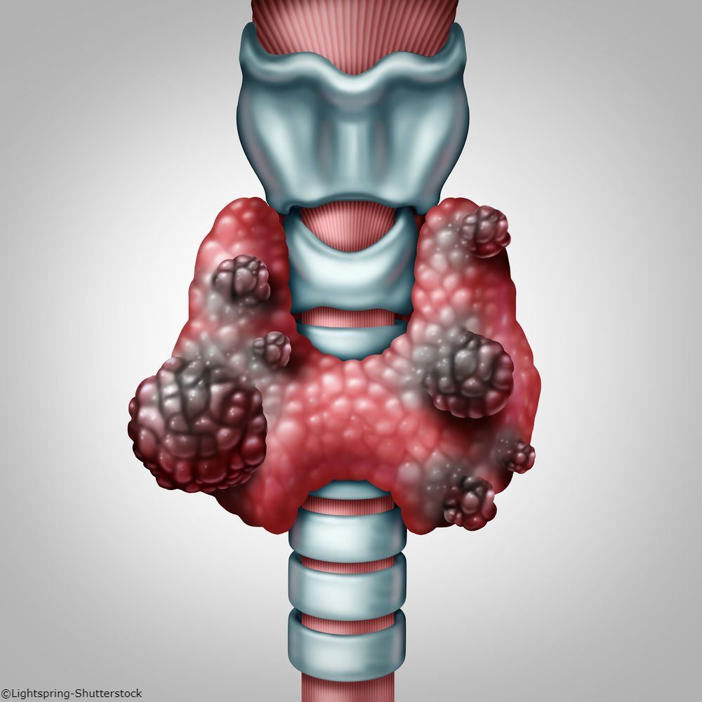 Thyroid Cancer Review Summarizes Strategies for Treatment and Diagnosis