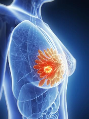 Datopotamab deruxtecan previously showed statistically significant improvement in progression-free survival in patients with HR+, HER2-low, or HER2-negative breast cancer.