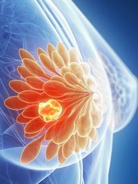 Gedatolisib Combinations Improve PFS in Advanced Breast Cancer
