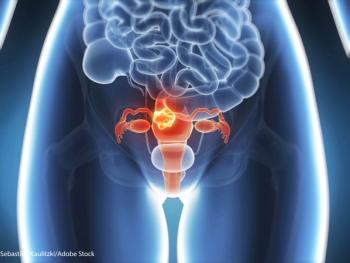 PAX8, a marker for aggressive disease in numerous cancer types, was more highly expressed in Black patients with uterine serous carcinoma.