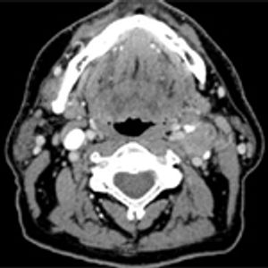 Emergence of a Novel Staging System for Oropharyngeal Squamous Cell Carcinoma Based on HPV Status