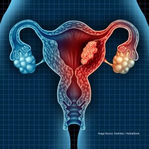Trial Failure Still Yields Insights for Uterine Leiomyosarcoma