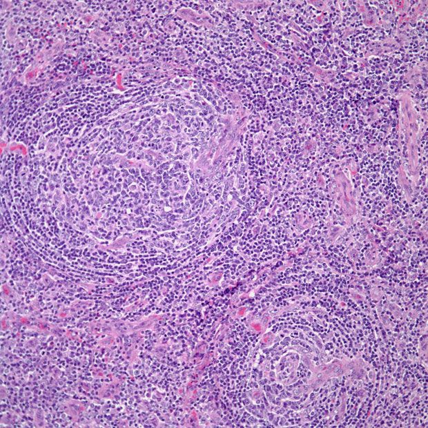 Enlarged Lymph Nodes in 39-Year-Old Patient | Cancer Network