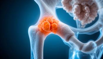 3D Medical Illustration of Bone Tumor in Hip Joint | © rdkcho - © rdkcho - stock.adobe.com