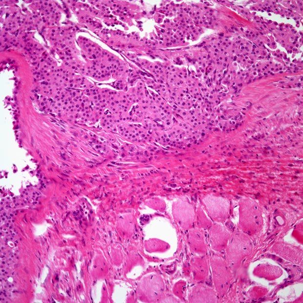 Slide Show: Follicular Thyroid Carcinoma and Hurthle Cell Cancer ...