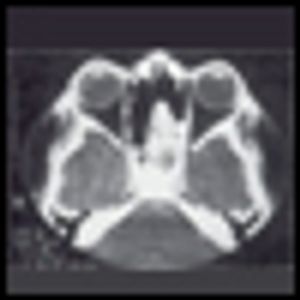 Current Imaging Techniques for Head and Neck Tumors