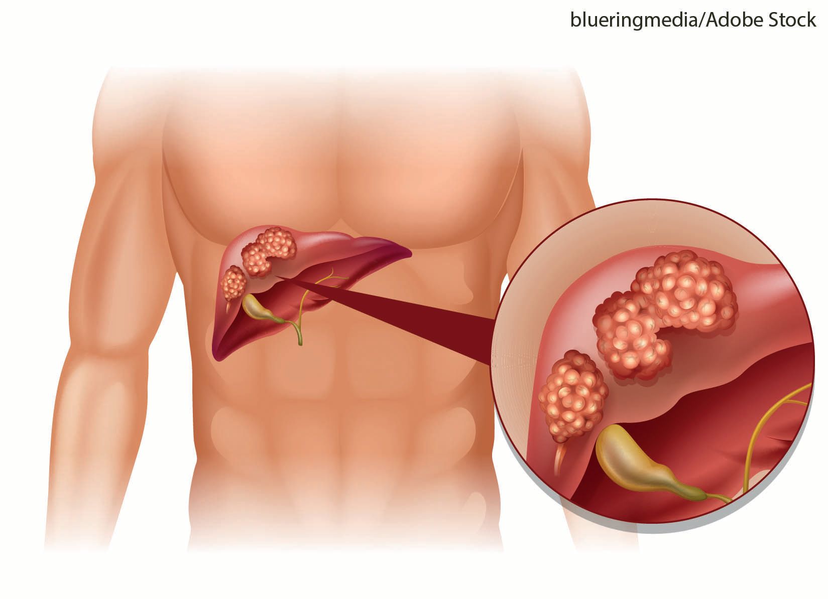 glp 1 neuroendocrine tumor Research Reveals Potential Risks of Popular GLP-1 Medications for Some with Cancer GLP-1 Receptor Agonists in Solid