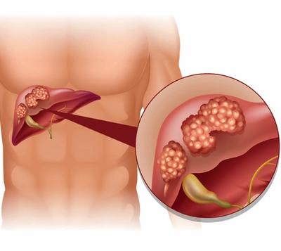 Micheal C. Soulen, MD, discussed his presentation of the phase 2 CapTemY90 trial assessing the combination of radioembolization and chemotherapy in patients with liver-dominant NETs at the 2025 North American Neuroendocrine Tumor Symposium.