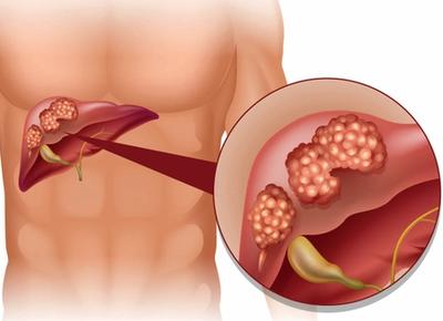 Micheal C. Soulen, MD, discussed his presentation of the phase 2 CapTemY90 trial assessing the combination of radioembolization and chemotherapy in patients with liver-dominant NETs at the 2025 North American Neuroendocrine Tumor Symposium.