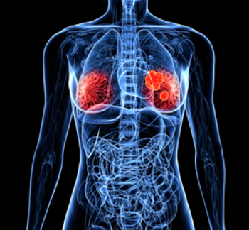 Findings suggest that sensitive circulating tumor DNA analysis may be a valuable tool for guiding neoadjuvant treatment decision-making in early-stage triple-negative breast cancer.