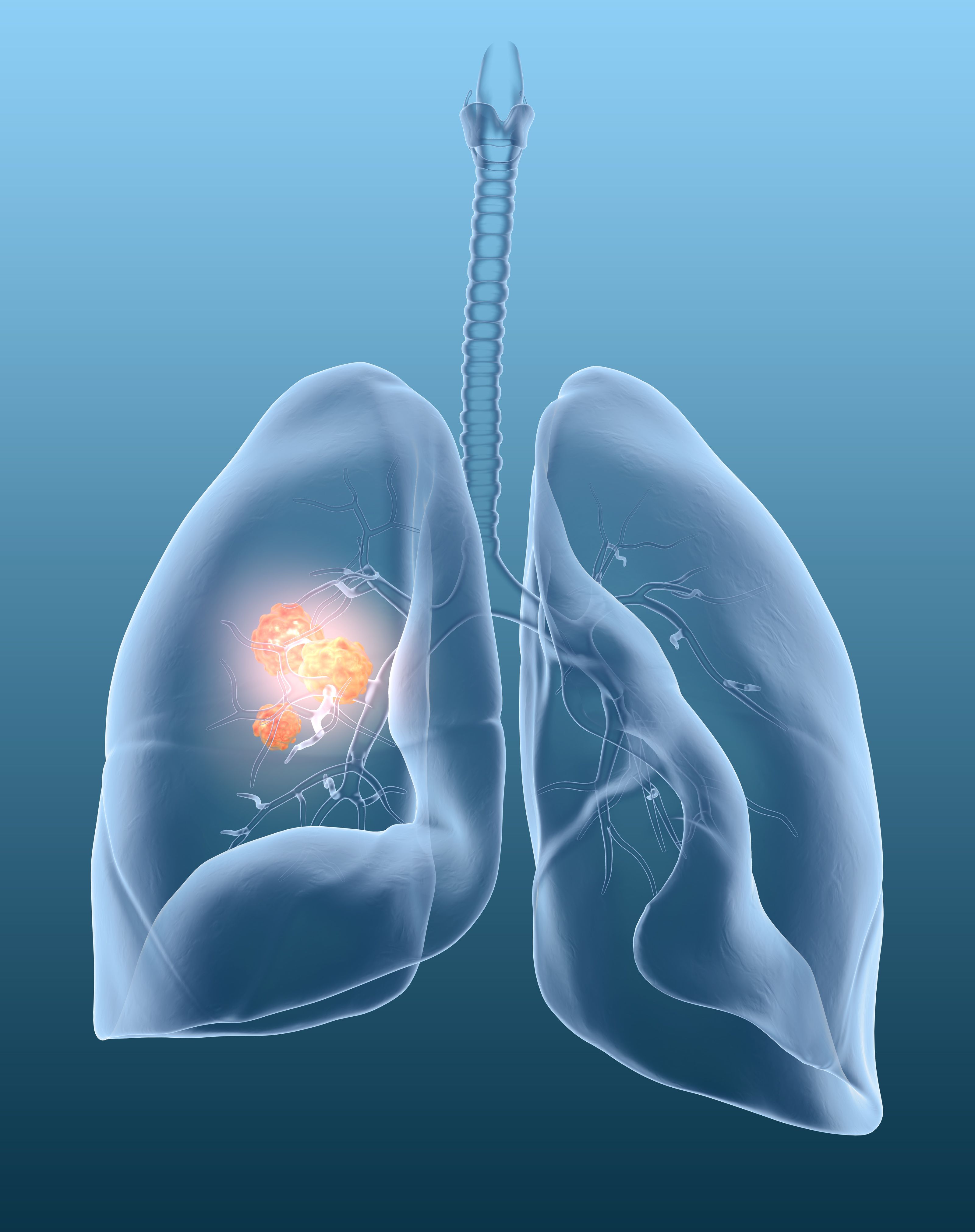 Molecular Therapy: Lung Cancer Leads The Way