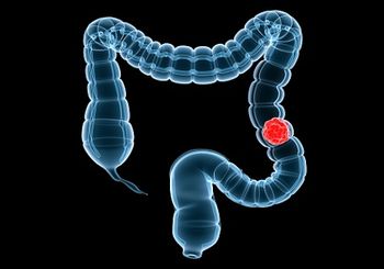 Exercise significantly enhances cancer treatment outcomes, improving survival rates and quality of life for patients with colon cancer who have completed therapy.