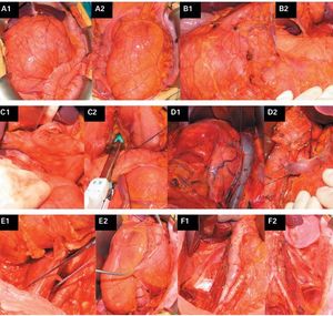 The Diagnosis and Management of Retroperitoneal Sarcoma