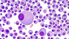 A Satellite Sessions program at the Yale Cancer Center discusses treatment paradigms and unmet needs in multiple myeloma as well as transplantation, bispecific T-cell engaging therapies, and the importance of collaborative decision-making in clinical practice.
