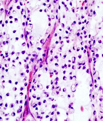 Patients with advanced well-differentiated/dedifferentiated liposarcoma may experience a positive progression-free rate following treatment with sitravatinib.