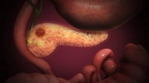 Genomic Predictors Associated With Exceptional Response to Systemic Therapy in Advanced Pancreatic Cancer