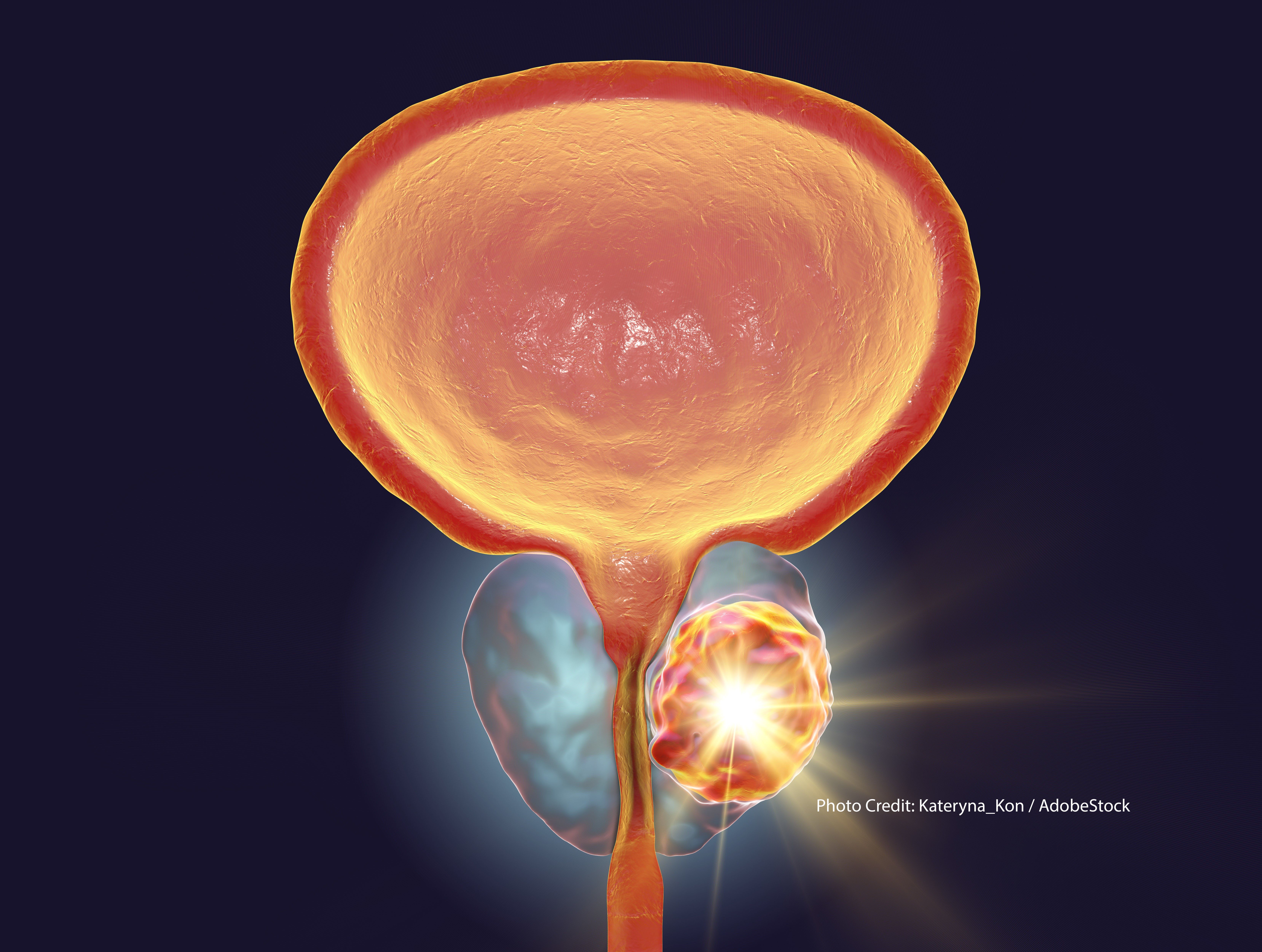 New Expert Guidance on EBRT in Men with EarlyStage