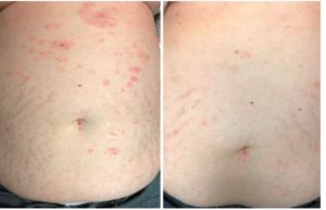 Progressive Red-to-Violaceous Papules and Plaques on the Neck and Abdominal Skin of a 70-Year-Old Woman