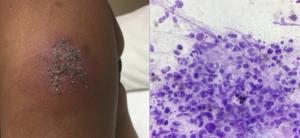 Skin Lesions in Patient With Metastatic Breast Cancer