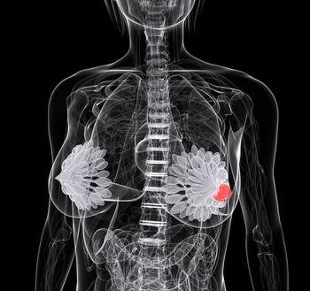 Updated findings from the phase 3 MONALESSA-3 trial identified a significant overall survival benefit among postmenopausal patients with hormone receptor–positive, HER2-negative breast cancer who were treated with ribociclib and fulvestrant vs matched placebo.
