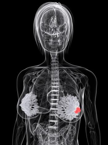 Axillary ultrasound and biopsy appear to be an effective strategy to identify nodal disease in patients with early-stage triple-negative breast cancer.
