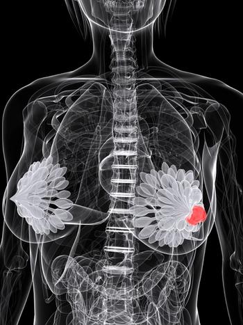 Updated findings from the phase 3 MONALESSA-3 trial identified a significant overall survival benefit among postmenopausal patients with hormone receptor–positive, HER2-negative breast cancer who were treated with ribociclib and fulvestrant vs matched placebo.