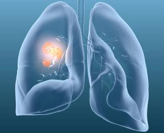 In a CancerNetwork® YouTube video, Cornelia Tischmacher, a mother of twins from Germany, outlined her receipt of double lung transplantation.