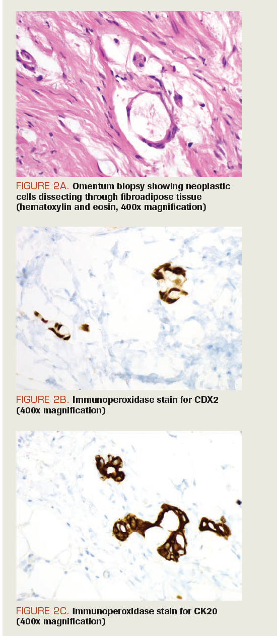 FIGURE 2A. Omentum biopsy showing neoplastic cells dissecting through fibroadipose tissue (hematoxylin and eosin, 400x magnification)

FIGURE 2B. Immunoperoxidase stain for CDX2 (400x magnification)

FIGURE 2C. Immunoperoxidase stain for CK20 (400x magnification)