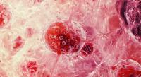 An Expert Panel Discusses CAR T-Cell Therapy in DLBCL: © Maryna - stock.adobe.com