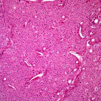 In the phase 3 RENOTORCH trial, frontline toripalimab plus axitinib appears to improve the overall response rate of patients with unresectable or metastatic renal cell carcinoma.