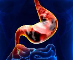 Bemarituzumab Plus mFOLFOX6 Demonstrates Promising Clinical Efficacy in Advanced Gastric Cancer